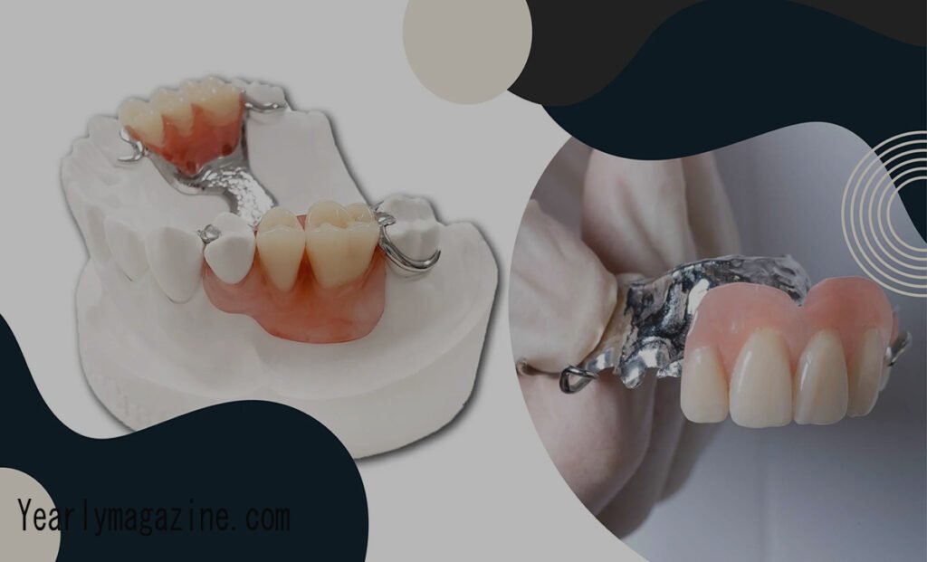 Cast Metal Partial Dentures: Your Complete Guide